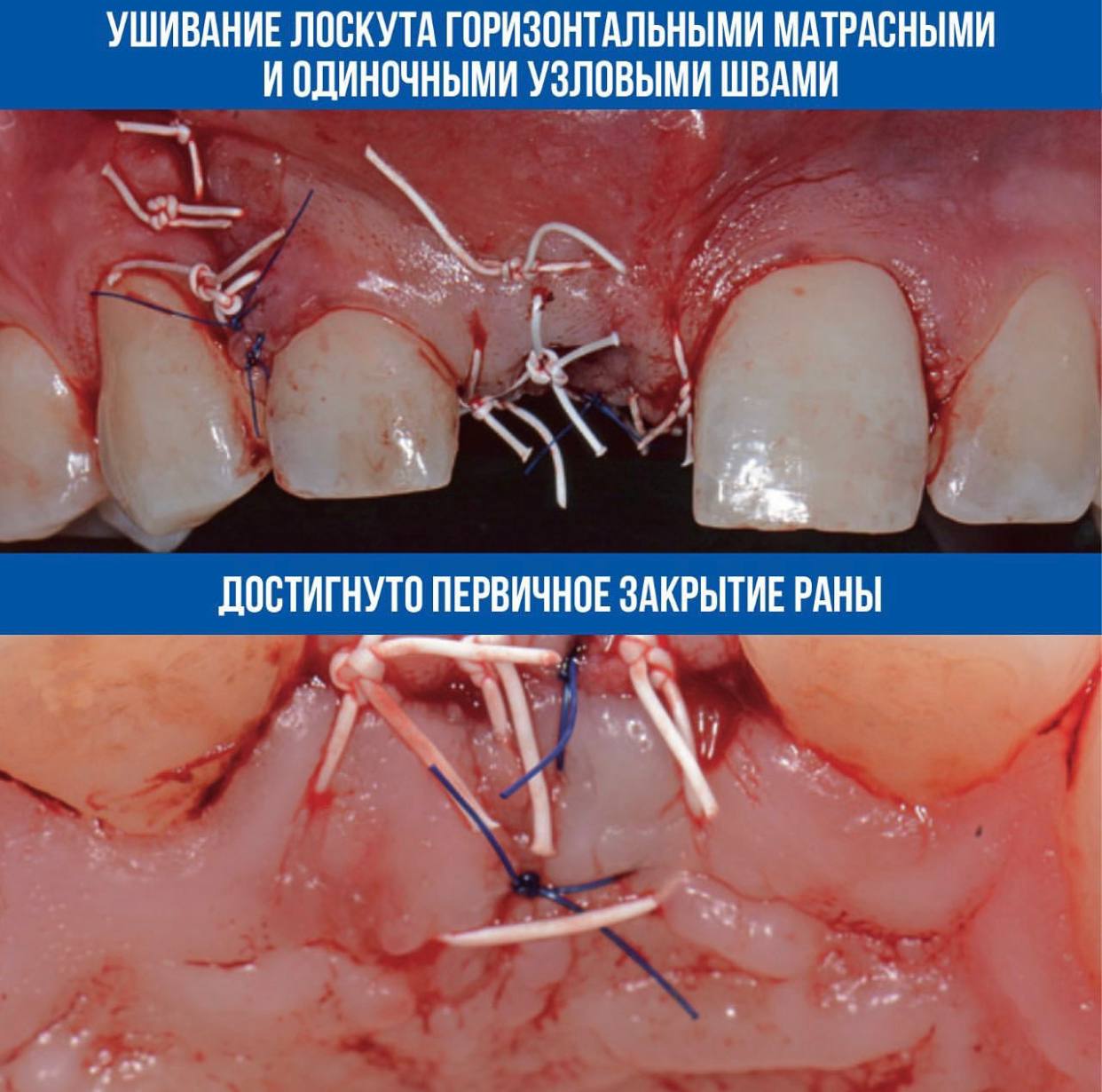 Техника L-shape. Клинический случай Рональда Юнга